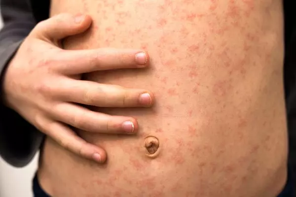 Detectan un caso de sarampión (Foto: Adobe Stock)